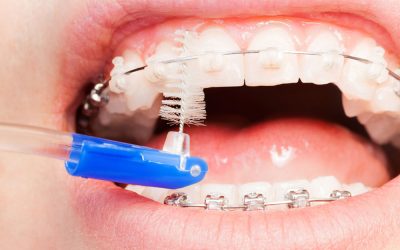 5 consejos sobre cómo limpiar la ortodoncia
