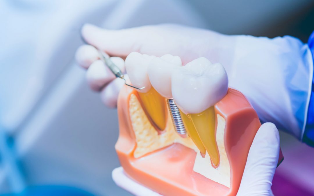 Diferencias entre prótesis e implantes dentales