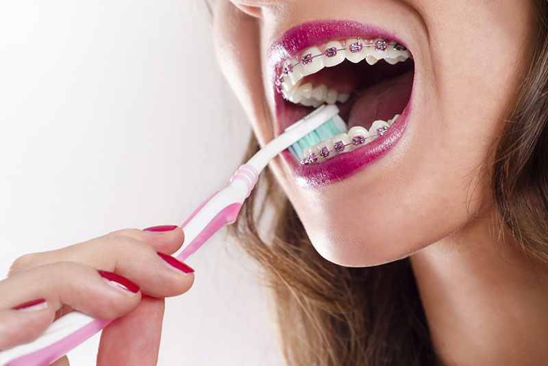 ¿Cómo cuidar tus dientes con brackets?