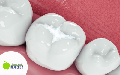 Consejos tras un empaste dental