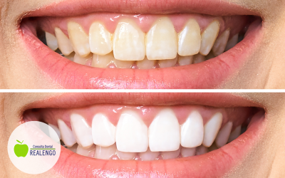 Blanqueamiento y sensibilidad dental
