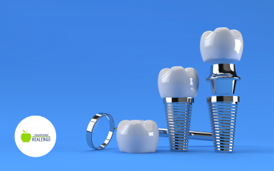 ¿Qué debes saber sobre el implante dental?