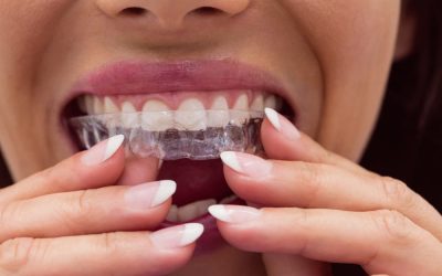 ¿Cuánto vale una ortodoncia invisible?