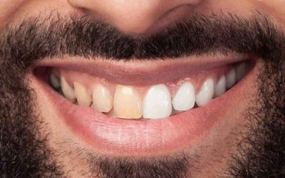 ¿Por qué se ponen los dientes amarillos?